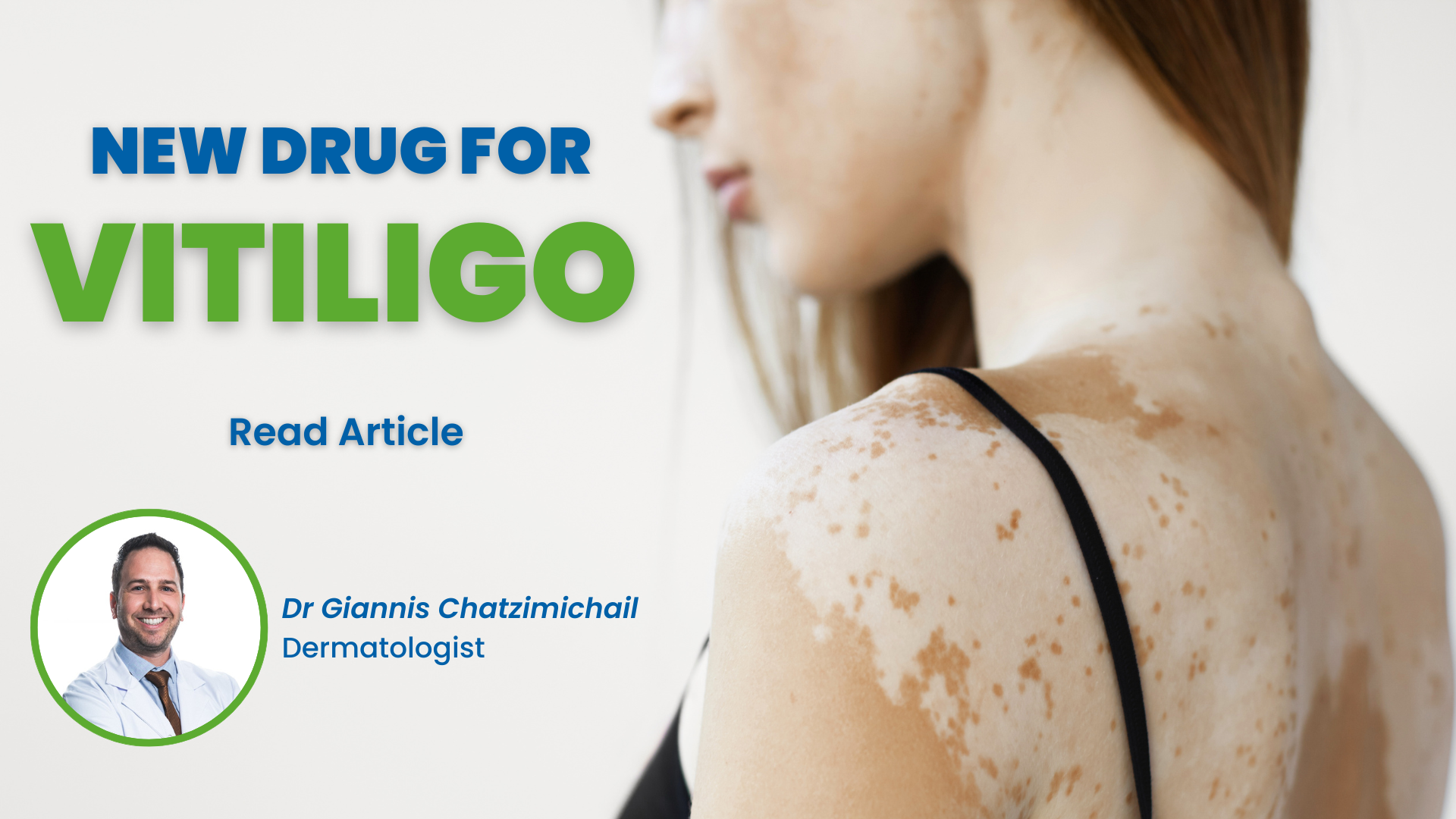 Effective treatment for Vitiligo?